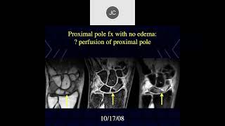 MRI of the Wrist Part 3  Wrist Trauma amp Bone Injuries [upl. by Iddet]