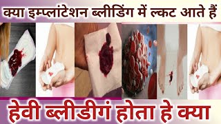 Kya Implantation bleeding me clots aate hai।Heavy Bleeding hoti hai।Implantation Bleeding Vs Periods [upl. by Mukund59]