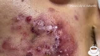 Pimple Pop React Pimple Blackheads cystic acne [upl. by Issej]