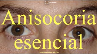 Anisocoria Esencial [upl. by Sonafets735]