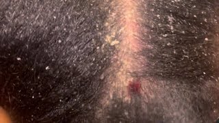 SebDerm Flare Up Flake Removal [upl. by Demha]