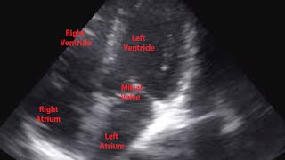 Echocardiogram of Premature Ventricular Contraction  Loop [upl. by Honorine]