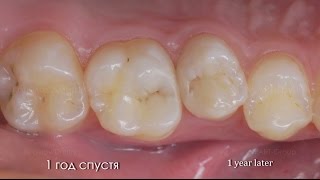 Лечение кариеса боковых зубов Реставрация композитом Composite tooth restoration [upl. by Aleina256]