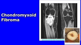 Chondromyxoid fibroma  A short summary of a strange benign tumor [upl. by Assened]