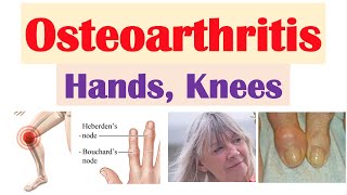 Osteoarthritis Arthritis of Hands Knees  Causes Risk Factors Symptoms Diagnosis Treatment [upl. by Joshuah]