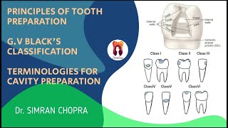 Principles for Tooth Preparation l GV Blacks Classification l Operative Dentistry [upl. by Meris]