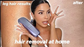 I TRIED LASER HAIR REMOVAL AT HOME this is what happened [upl. by Eiralam893]