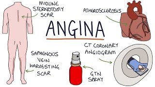 Understanding Angina Visual Explanation for Students [upl. by Laet]