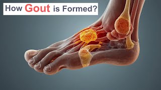 How Gout is Formed [upl. by Acus771]