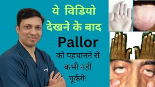 Pallor ExaminationPallor meaningPallor grading in hindi [upl. by Septima]