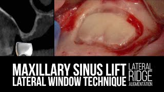 Maxillary Sinus Lift with Lateral Window Technique with Lateral Ridge Augmentation [upl. by Henderson]