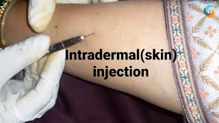 intradermal or skin injection [upl. by Etteoj199]