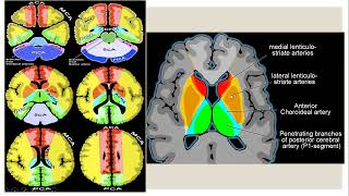 Neuroradiology case presentation session 2 [upl. by Hocker]