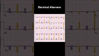 Electrical Alternans ECG Example 1 [upl. by Aniloj299]