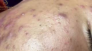 Loan Nguyen Acne Treatment 1623h [upl. by Trainer]