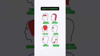 Types of Headaches headache headpain [upl. by Monarski481]