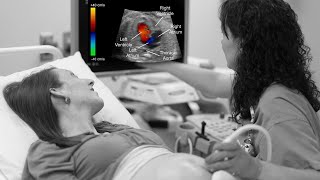 Fetal Echo I फीटल इको क्या है I Fetal Circulation I Dr Amitha Indersen [upl. by Airdnoed]