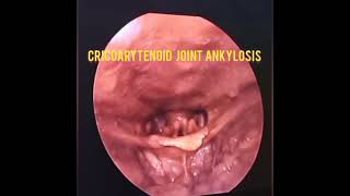 SEE WHAT ANKYLOSIS OF THE CRICOARYTENOID JOINT LOOKS LIKE [upl. by Beora538]