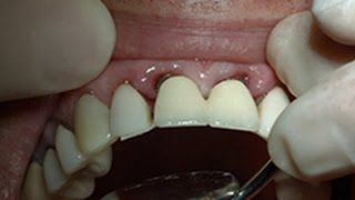 Bicon Immediate Loading Technique Using a TRINIA™ Stabilizing Prosthesis [upl. by Sew]