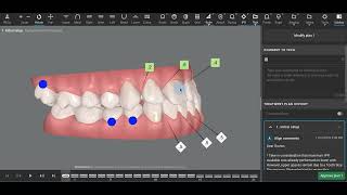 Class III Invisalign [upl. by Minabe]