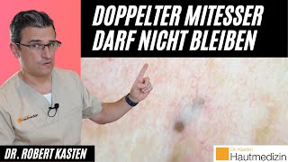 Doppelt endender Mitesser Darf nicht bleiben  Dr Kasten Hautmedizin in Mainz mitesser [upl. by Anirav445]