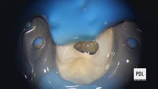 Live Stream Molar Endodontic Treatment Video Complex Anatomy with Detailed Narrative [upl. by Hans]