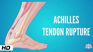 Achilles tendon rupture Causes Signs and Symptoms Diagnosis and Treatment [upl. by Mamoun794]