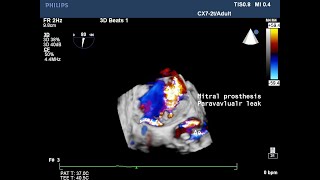 Paravalvular leak of mitral prosthesis [upl. by Mindi]