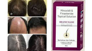 BRAND NAME SOLUTION Minoxidil amp Finasteride Topical Solution Revitalizes Hair Follicles [upl. by Brink]