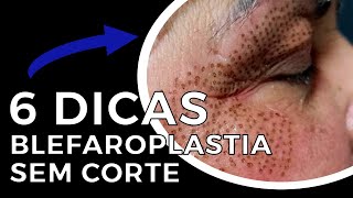 Como fazer a Blefaroplastia sem Corte  6 DICAS [upl. by Demb]