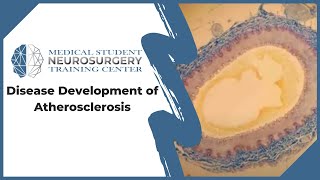 Disease Development of Atherosclerosis [upl. by Corson]