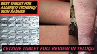 BEST TABLET FOR ALLERGY AND SKIN RASHES AND ITCHINGCETZINE TABLET USES DOSE FULL REVIEW IN TELUGU [upl. by Haida]