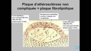 Athérosclérose Anatomie Pathologique Partie 2 [upl. by Yntruoc454]