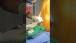 Spinal Anesthesia doctor childbirth hospital postdelivery backpainrelief medicalstudent [upl. by Poree]