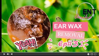 Ear Wax Removal Expert Shares Top Techniques [upl. by Talya]