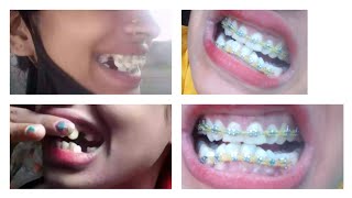 Mybraces journey  bracesexperience videos before and after pic👍😔पूराvideoजरुऱ देख़ना [upl. by Nerrak]