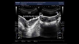 Ultrasound Video showing a rare case of Hematocolpos with Single Kidney [upl. by Zelazny]