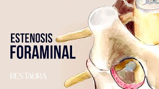 Estenosis Foraminal  ¿Qué significa estrechamiento neuroforaminal [upl. by Agan]