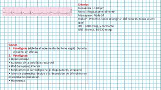 Bradicardia SINUSAL  Clases EKG 38 [upl. by Garwood]