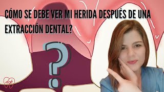 CÓMO SE VE LA HERIDA DESPUÉS DE UNA EXTRACCIÓN DENTAL MEJOR RESÚMEN 2021 [upl. by Nnylsia]