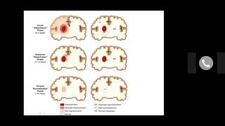 The Long and Winding Road Recovery from Intracerebral Hemorrhage  Charmaine MartinGaspar NP [upl. by Eagle]