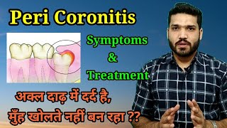 Peri coronitis  symptoms amp treatment  अक्ल दाढ़ दर्द का एक कारण [upl. by Ydnis]