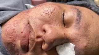 ACNE TREATMENT BO NGUYỄN  Blackheads Removal New 2024 [upl. by Enasus]