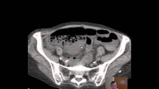 CT Bowel Ischemia [upl. by Macnair]