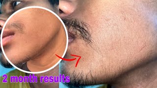 Minoxidil beard growth  2 month beard journey  transformation [upl. by Ahsiuqram137]