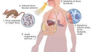 Hantavirus Treatment [upl. by Volney]