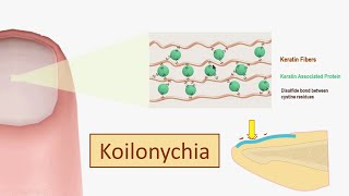 How Koilonychia develops in Iron Deficiency Anemia  Koilonychia spoon nails pathogenesis [upl. by Kaleena62]