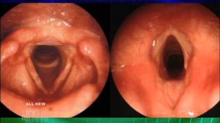 Hoarseness Explained Medical Course [upl. by Florence60]