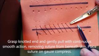 Continuous Suture Removal [upl. by Marrin]