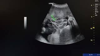 ultrasound case shows a fetus with gastroschisis [upl. by Solon]